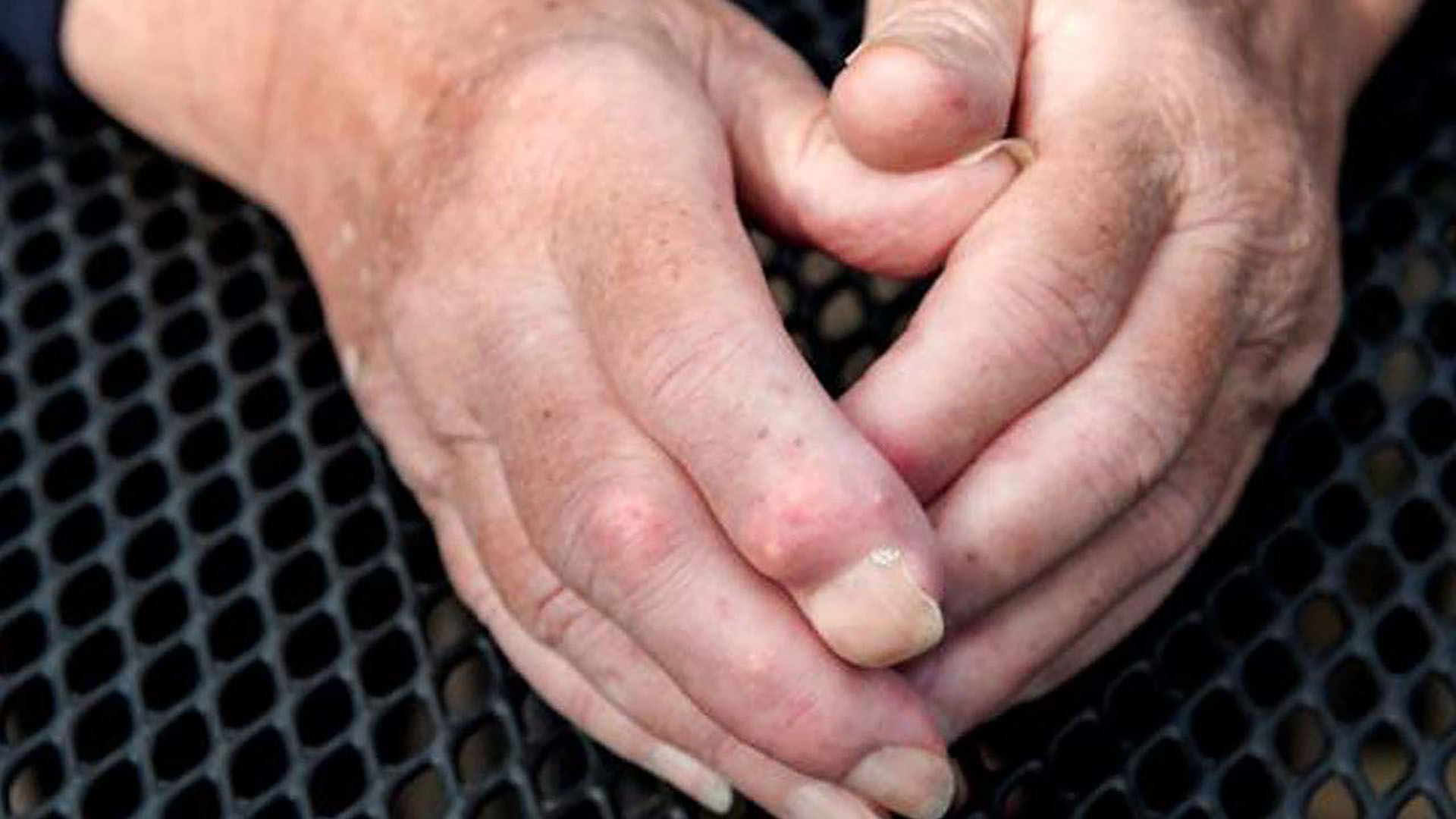 Sert-yumrular-(kalsinoz)