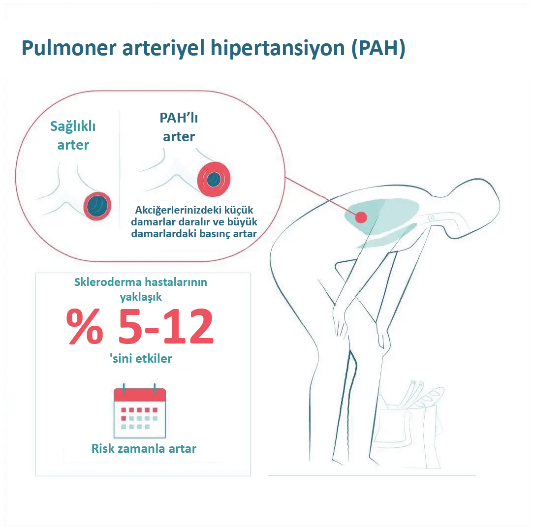 3-4-pulmonary_arterial_hypertension_pah_infographic_more_than_scleroderma_boehringer_ingelheim_0.png Alternatif metin